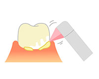 歯と歯間の清掃をします